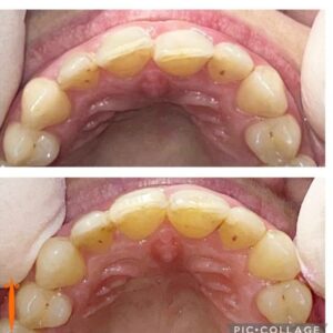 braces-at-k3