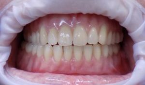 optimal-fit-dentures-k3-dental-studio